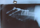 Röntgenbild linker Oberarm nach OP